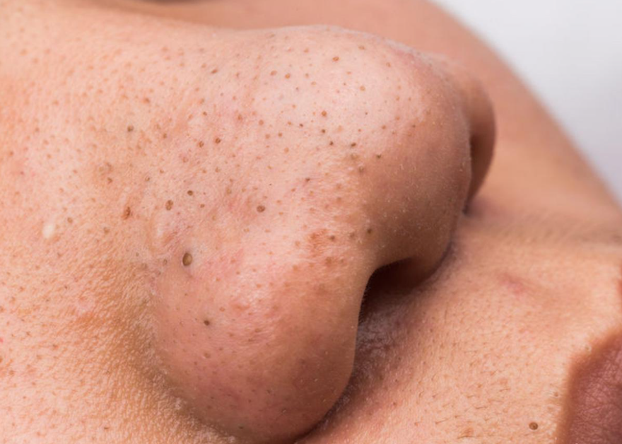 Tips Melenyapkan Komedo Dengan Memanfaatkan Bahan-Bahan Alami